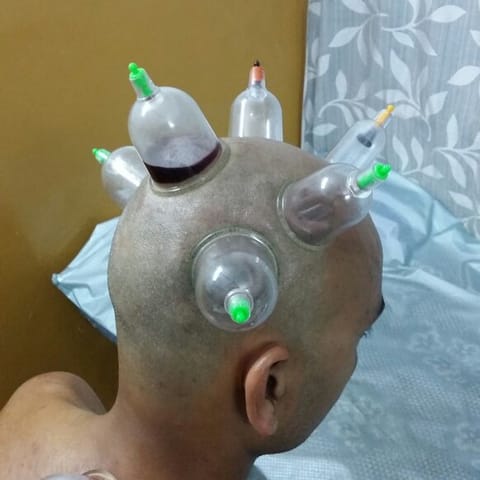 किशनगंज में शुरू हुआ हिजामा (कपिंग) थेरेपी सेंटर