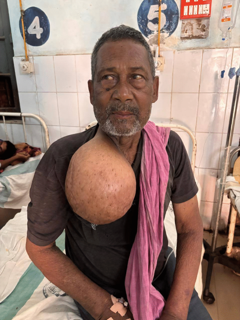 पूर्णिया GMCH के डॉक्टरों ने गरीब मजदूर को दी नई जिंदगी